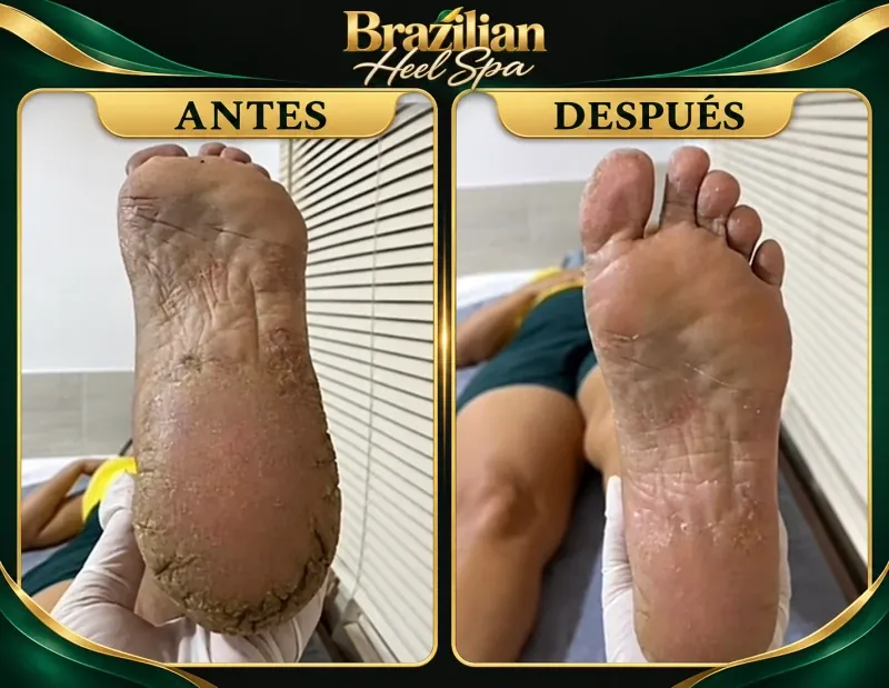 Comparación de la planta del pie antes y después